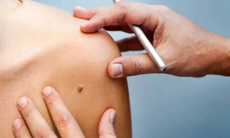 A Practical Guide to Managing Common Benign Skin Growths